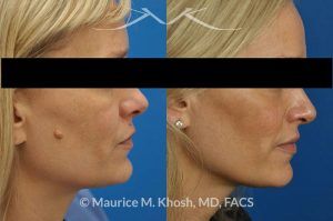 Photo of a patient before and after a procedure. Mole removal from the right cheek - before and after results.