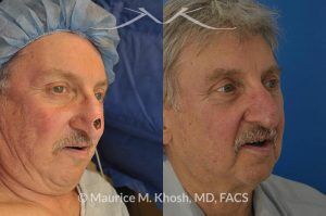 Photo of a patient before and after a procedure. Repair of Moh's defect of the lower nose after removal of basal cell cancer of skin. Bilobed flap technique - before and after photos.