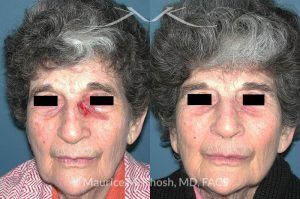 Photo of a patient before and after a procedure. Nose Moh's skin cancer repair - before and after photos.