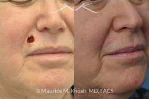 Photo of a patient before and after a procedure. Upper lip Mohs cancer defect repair - before and after photos.