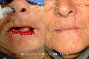 Photo of a patient before and after a procedure. Repair of 60% lower lip defect with Abbe lip switch technique - before and after photos.