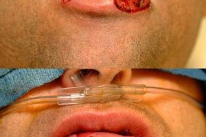 Photo of a patient before and after a procedure. Lower lip repair with advancement flaps - before and after photos.