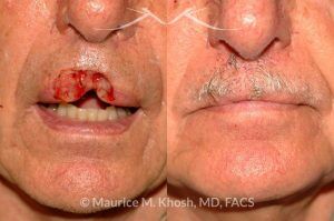 Photo of a patient before and after a procedure. Upper lip repair with bilateral davancement flaps - before and after photos.
