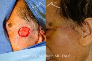Photo of a patient before and after a procedure. Upper cheek and temple reconstruction with mustarde advancement flap - before and after photos.