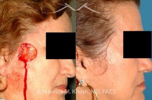 Photo of a patient before and after a procedure. Mohs cancer defect of the face - Upper cheek & temple reconstruction with mustarde cheek advancement.