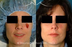 Photo of a patient before and after a procedure. Mohs defect of the central cheek repaired with bilateral local advancement flaps - before and after photos.