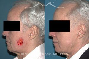 Photo of a patient before and after a procedure. Mohs defect of the lower cheek with a transposition flap - before and after photos.