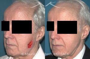 Photo of a patient before and after a procedure. Mohs defect of the lower cheek with a transposition flap - before and after photos.