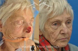 Photo of a patient before and after a procedure. Nose Moh's skin cancer repair, utilizing forehead flap and ear cartilage graft - before and after photos.