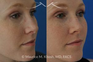 Photo of a patient before and after a procedure. Mole removal from cheek skin near the nose - before and after results.