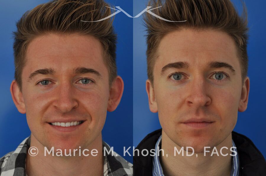 Ear pinning to push back excessively projected ears and flatten ears