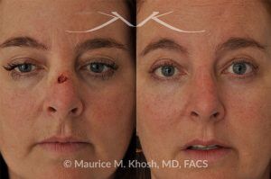 Photo of a patient before and after a procedure. Mohs skin reconstruction - This 51 year old underwent Mohs excision of Basal Cell Cancer of the skin of the bridge of her nose. Skin flaps from the bridge of the nose were used to perform the mohs skin defect repair. The result of the cancer reconstruction is only a barely visible scar in the center of the nose.