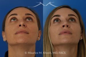 Photo of a patient before and after a procedure. Rhinoplasty to Elevate and Refine the Nasal Tip - This delightful 30 year-old was interested in rhinoplasty in New York, to elevate and refine her nasal tip. An open approach rhinoplasty was used to rotate and shorten the tip. Providing the results which perfectly matched her expectations .