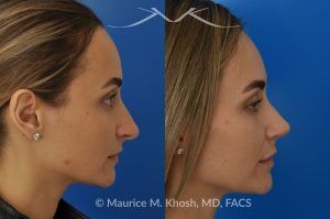 Photo of a patient before and after a procedure. Rhinoplasty to Elevate and Refine the Nasal Tip - This delightful 30 year-old was interested in rhinoplasty in New York, to elevate and refine her nasal tip. An open approach rhinoplasty was used to rotate and shorten the tip. Providing the results which perfectly matched her expectations .