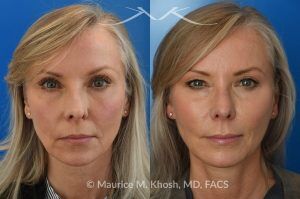 Photo of a patient before and after a procedure. Rhinoplasty for Crooked Nose, Nasal Hump, and Severe Obstruction - This amazing 65 year-old had chronic severe right sided nasal obstruction, deviation of the nose to the left side, and a small nasal hump. Surgery to address her concerns included: open approach rhinoplasty, septoplasty, right sided spreader graft, right sided septum extension graft, and a small right sided alar strut graft. She is delighted with the improved breathing and the straight appearing nasal bridge. 