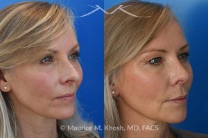 Photo of a patient before and after a procedure. Rhinoplasty for Crooked Nose, Nasal Hump, and Severe Obstruction - This amazing 65 year-old had chronic severe right sided nasal obstruction, deviation of the nose to the left side, and a small nasal hump. Surgery to address her concerns included: open approach rhinoplasty, septoplasty, right sided spreader graft, right sided septum extension graft, and a small right sided alar strut graft. She is delighted with the improved breathing and the straight appearing nasal bridge. 