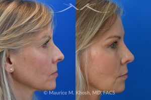 Photo of a patient before and after a procedure. Rhinoplasty for Crooked Nose, Nasal Hump, and Severe Obstruction - This amazing 65 year-old had chronic severe right sided nasal obstruction, deviation of the nose to the left side, and a small nasal hump. Surgery to address her concerns included: open approach rhinoplasty, septoplasty, right sided spreader graft, right sided septum extension graft, and a small right sided alar strut graft. She is delighted with the improved breathing and the straight appearing nasal bridge. 