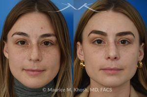 Photo of a patient before and after a procedure. Rhinoplasty to Straighten the Tip and Reduce Nasal Hump - before-and-after composite photo.