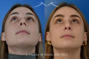 Photo of a patient before and after a procedure. Rhinoplasty to Straighten the Tip and Reduce Nasal Hump - before-and-after composite photo.