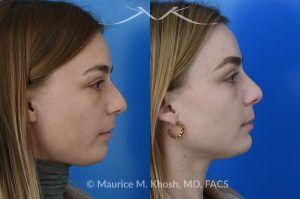 Photo of a patient before and after a procedure. Rhinoplasty to Straighten the Tip and Reduce Nasal Hump - before-and-after composite photo.
