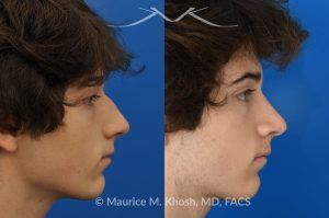 Photo of a patient before and after a procedure. Nose Hump Removal - This 18 year old sought rhinoplasty consultation in our Manhattan office, to remove a hump from the bridge of his nose. Rhinoplasty was performed through a closed approach to straighten the profile. 
