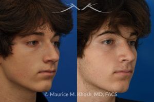 Photo of a patient before and after a procedure. Nose Hump Removal - This 18 year old sought rhinoplasty consultation in our Manhattan office, to remove a hump from the bridge of his nose. Rhinoplasty was performed through a closed approach to straighten the profile. 
