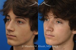 Photo of a patient before and after a procedure. Nose Hump Removal - This 18 year old sought rhinoplasty consultation in our Manhattan office, to remove a hump from the bridge of his nose. Rhinoplasty was performed through a closed approach to straighten the profile. 