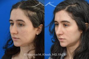 Photo of a patient before and after a procedure. Rhinoplasty for Droopy Tip and Small Hump - Patient sought septoplasty and rhinoplasty in our Manhattan office to address chronic nasal obstruction, deviated appearing bridge, a small dorsal hump, and sagging nasal tip. Surgery was performed through a closed approach (endo-nasal approach). The results show the one year result. She is ecstatic with the breathing and aesthetic results.