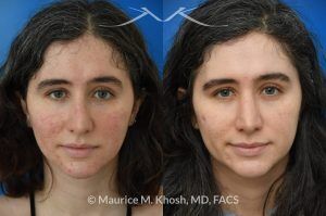 Photo of a patient before and after a procedure. Rhinoplasty for Droopy Tip and Small Hump - Patient sought septoplasty and rhinoplasty in our Manhattan office to address chronic nasal obstruction, deviated appearing bridge, a small dorsal hump, and sagging nasal tip. Surgery was performed through a closed approach (endo-nasal approach). The results show the one year result. She is ecstatic with the breathing and aesthetic results.