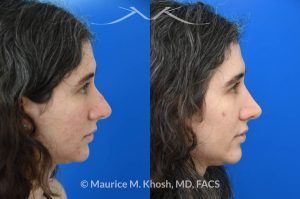 Photo of a patient before and after a procedure. Rhinoplasty for Droopy Tip and Small Hump - Patient sought septoplasty and rhinoplasty in our Manhattan office to address chronic nasal obstruction, deviated appearing bridge, a small dorsal hump, and sagging nasal tip. Surgery was performed through a closed approach (endo-nasal approach). The results show the one year result. She is ecstatic with the breathing and aesthetic results.