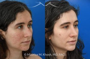 Photo of a patient before and after a procedure. Rhinoplasty for Droopy Tip and Small Hump - Patient sought septoplasty and rhinoplasty in our Manhattan office to address chronic nasal obstruction, deviated appearing bridge, a small dorsal hump, and sagging nasal tip. Surgery was performed through a closed approach (endo-nasal approach). The results show the one year result. She is ecstatic with the breathing and aesthetic results.