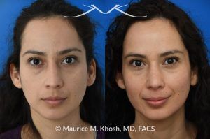 Photo of a patient before and after a procedure. Subtle Rhinoplasty to Elevate Tip and Improve Dorsal Hump - This lovely patient sought rhinoplasty consultation to achieve a subtle alteration in the shape of her nose. She wanted a slight lift of her nasal tip and reduction of the dorsal hump. She did not wish to have a significant change or an unnatural result. As you can see in the last two images in this series, the simulation results shown in the middle photos match the final results fairly closely. She is ecstatic with her results.