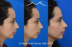 Photo of a patient before and after a procedure. Subtle Rhinoplasty to Elevate Tip and Improve Dorsal Hump - This lovely patient sought rhinoplasty consultation to achieve a subtle alteration in the shape of her nose. She wanted a slight lift of her nasal tip and reduction of the dorsal hump. She did not wish to have a significant change or an unnatural result. As you can see in the last two images in this series, the simulation results shown in the middle photos match the final results fairly closely. She is ecstatic with her results.
