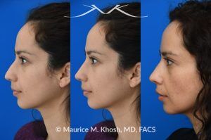 Photo of a patient before and after a procedure. Subtle Rhinoplasty to Elevate Tip and Improve Dorsal Hump - This lovely patient sought rhinoplasty consultation to achieve a subtle alteration in the shape of her nose. She wanted a slight lift of her nasal tip and reduction of the dorsal hump. She did not wish to have a significant change or an unnatural result. As you can see in the last two images in this series, the simulation results shown in the middle photos match the final results fairly closely. She is ecstatic with her results.
