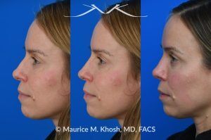 Photo of a patient before and after a procedure. Nasal Hump Reduction and Tip Narrow - This young lady had septum deviation which affected her breathing and caused asymmetry of her nostrils. She wanted to smooth a small nasal hump and narrow her tip in a conservative manner. The last two images show her pre op profile (on the left), the computer simulation (in the middle), and the final results (on the right). 