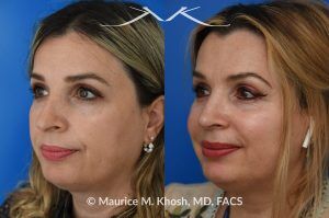 Photo of a patient before and after a procedure. Rhinoplasty for Droopy and Twisted Tip and Dorsum Deviation to the Right - This delightful patient wanted to address a twisted and droopy nasal tip. An open approach was used to reduce the nasal hump, elevate and refine the nasal tip. She is ecstatic with the results of her rhinoplasty. 