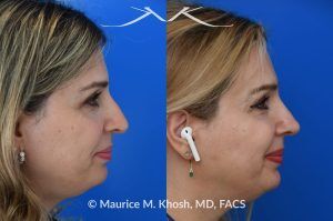 Photo of a patient before and after a procedure. Rhinoplasty for Droopy and Twisted Tip and Dorsum Deviation to the Right - This delightful patient wanted to address a twisted and droopy nasal tip. An open approach was used to reduce the nasal hump, elevate and refine the nasal tip. She is ecstatic with the results of her rhinoplasty. 