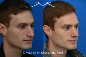 Photo of a patient before and after a procedure. Rhinoplasty for Long and Droopy Tip and Nasal Hump - This young professional wanted improved breathing and enhancement of his nasal appearance. An open rhinoplasty  was used to lower the nasal bridge and narrow and elevate the nasal tip.