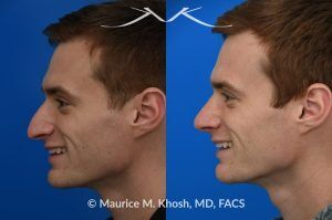 Photo of a patient before and after a procedure. Rhinoplasty for Long and Droopy Tip and Nasal Hump - This young professional wanted improved breathing and enhancement of his nasal appearance. An open rhinoplasty  was used to lower the nasal bridge and narrow and elevate the nasal tip.