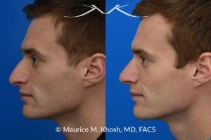 Photo of a patient before and after a procedure. Rhinoplasty for Long and Droopy Tip and Nasal Hump - This young professional wanted improved breathing and enhancement of his nasal appearance. An open rhinoplasty  was used to lower the nasal bridge and narrow and elevate the nasal tip.