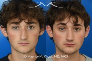 Photo of a patient before and after a procedure.  Rhinoplasty for Nasal Obstruction, Large Nasal Hump, and Droopy Nasal Tip - This young patient had a severely deviated septum which caused nasal obstruction. During an open rhinoplasty, the septum deviation was addressed. The nasal hump was reduced while preserving his overall facial appearance. The droopy nasal hump was corrected with the use of septo-columellar sutures. A small cartilage graft was applied to the excessively deep naso-forntal angle (radix). 