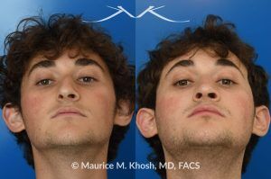Photo of a patient before and after a procedure.  Rhinoplasty for Nasal Obstruction, Large Nasal Hump, and Droopy Nasal Tip - This young patient had a severely deviated septum which caused nasal obstruction. During an open rhinoplasty, the septum deviation was addressed. The nasal hump was reduced while preserving his overall facial appearance. The droopy nasal hump was corrected with the use of septo-columellar sutures. A small cartilage graft was applied to the excessively deep naso-forntal angle (radix). 