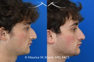 Photo of a patient before and after a procedure.  Rhinoplasty for Nasal Obstruction, Large Nasal Hump, and Droopy Nasal Tip - This young patient had a severely deviated septum which caused nasal obstruction. During an open rhinoplasty, the septum deviation was addressed. The nasal hump was reduced while preserving his overall facial appearance. The droopy nasal hump was corrected with the use of septo-columellar sutures. A small cartilage graft was applied to the excessively deep naso-forntal angle (radix). 