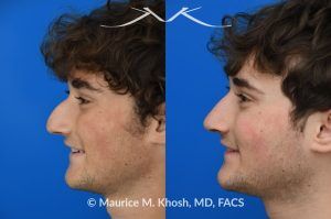 Photo of a patient before and after a procedure.  Rhinoplasty for Nasal Obstruction, Large Nasal Hump, and Droopy Nasal Tip - This young patient had a severely deviated septum which caused nasal obstruction. During an open rhinoplasty, the septum deviation was addressed. The nasal hump was reduced while preserving his overall facial appearance. The droopy nasal hump was corrected with the use of septo-columellar sutures. A small cartilage graft was applied to the excessively deep naso-forntal angle (radix). 