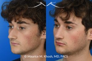 Photo of a patient before and after a procedure.  Rhinoplasty for Nasal Obstruction, Large Nasal Hump, and Droopy Nasal Tip - This young patient had a severely deviated septum which caused nasal obstruction. During an open rhinoplasty, the septum deviation was addressed. The nasal hump was reduced while preserving his overall facial appearance. The droopy nasal hump was corrected with the use of septo-columellar sutures. A small cartilage graft was applied to the excessively deep naso-forntal angle (radix). 