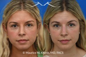 Photo of a patient before and after a procedure. Subtle Rhinoplasty for Dorsum Deviation to the Right Side - This wonderful patient had a minor imperfection in her nose. The nasal dorsum deviated to the right side and she had a very minor bony hump. I used a closed rhinoplasty approach. The nasal hump was shaved. The dorsum deviation was addressed with spreader-graft application to the left side.