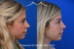 Photo of a patient before and after a procedure. Subtle Rhinoplasty for Dorsum Deviation to the Right Side - This wonderful patient had a minor imperfection in her nose. The nasal dorsum deviated to the right side and she had a very minor bony hump. I used a closed rhinoplasty approach. The nasal hump was shaved. The dorsum deviation was addressed with spreader-graft application to the left side.