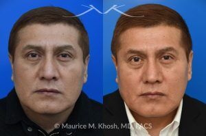Photo of a patient before and after a procedure. Rhinoplasty for Droopy TIp - This gentleman had suffered a nasal fracture and noted breathing obstruction and poor nasal tip support which gave his nasal tip a droopy appearance. Septoplast was performed to restore his breathing. An open rhinoplasty approach was used to place bilateral septum extension grafts and a cap graft to improve the position and contour of the nose. He is ecstatic about his breathing capacity and nasal appearance following his rhinoplasty in New York.