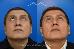 Photo of a patient before and after a procedure. Rhinoplasty for Droopy TIp - This gentleman had suffered a nasal fracture and noted breathing obstruction and poor nasal tip support which gave his nasal tip a droopy appearance. Septoplast was performed to restore his breathing. An open rhinoplasty approach was used to place bilateral septum extension grafts and a cap graft to improve the position and contour of the nose. He is ecstatic about his breathing capacity and nasal appearance following his rhinoplasty in New York.