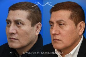 Photo of a patient before and after a procedure. Rhinoplasty for Droopy TIp - This gentleman had suffered a nasal fracture and noted breathing obstruction and poor nasal tip support which gave his nasal tip a droopy appearance. Septoplast was performed to restore his breathing. An open rhinoplasty approach was used to place bilateral septum extension grafts and a cap graft to improve the position and contour of the nose. He is ecstatic about his breathing capacity and nasal appearance following his rhinoplasty in New York.